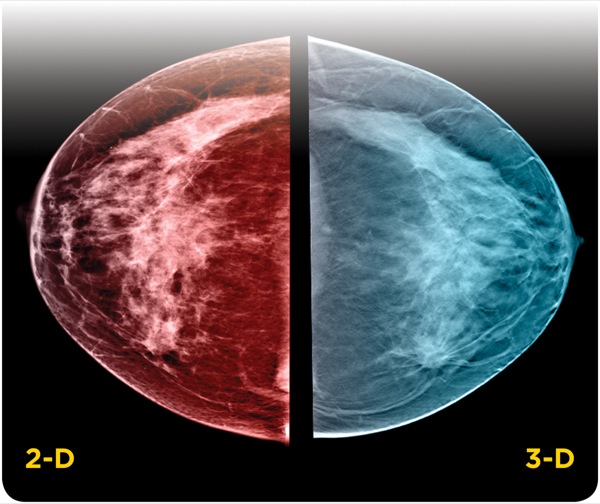 Study of role of digital breast tomosynthesis over digital