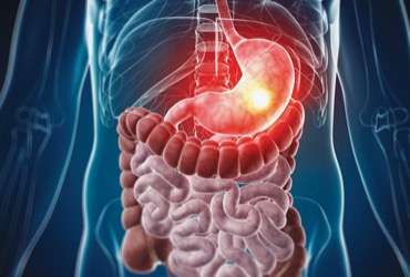 Patients With IBD Face Range of Extraintestinal Cancers